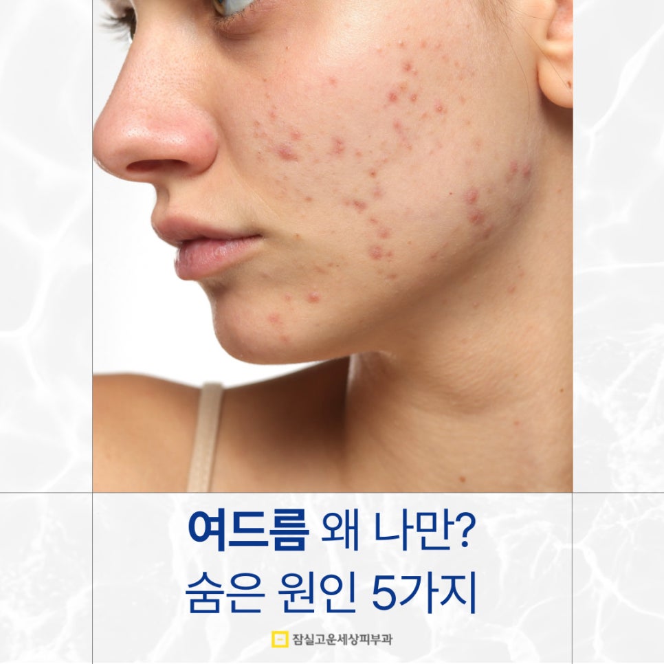 왜 나만 여드름이 사라지지 않을까? 숨은 원인 5가지 관련 이미지 1
