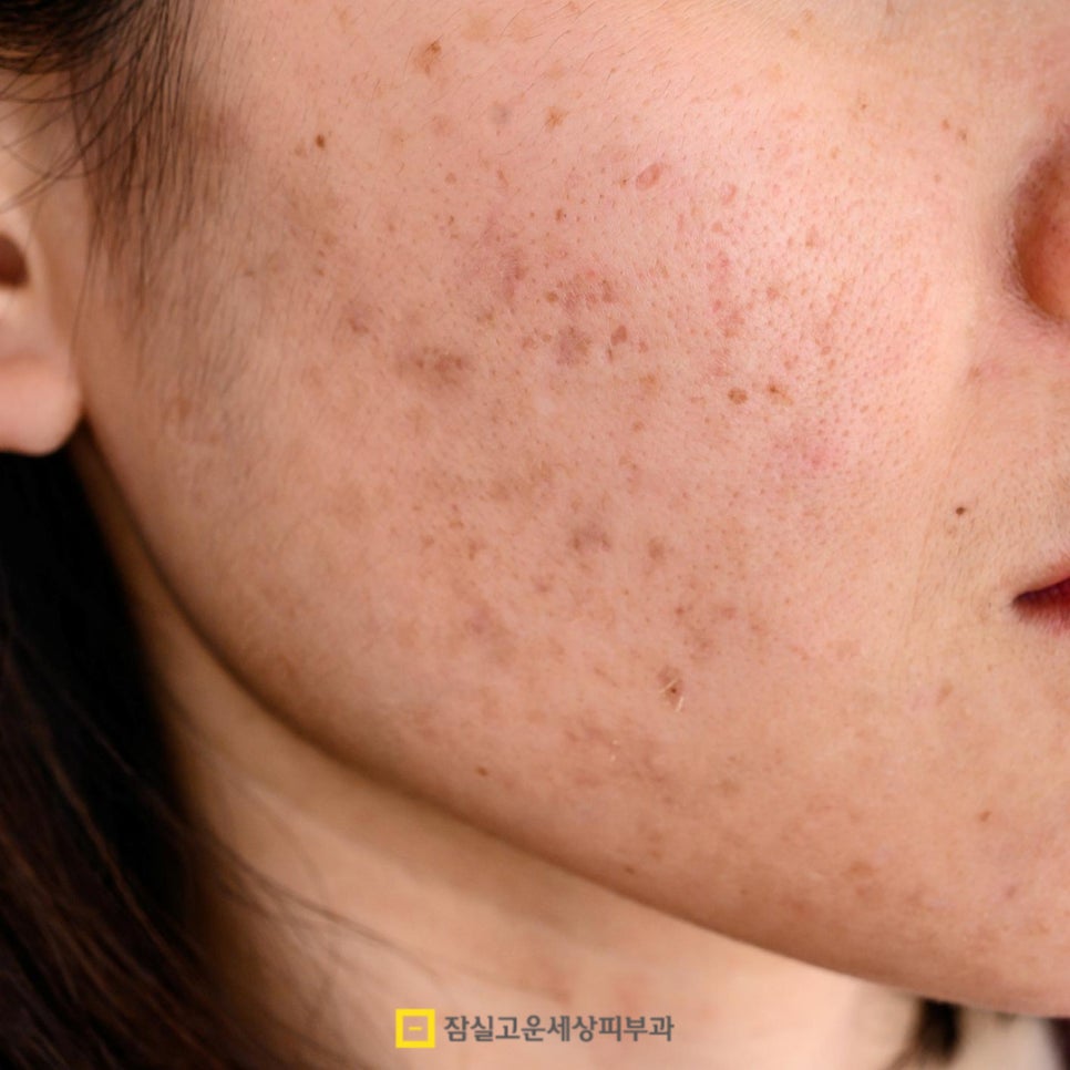 여드름, 왜 치료해도 다시 올라올가? 그리고 재발을 줄이는 방법 관련 이미지 9