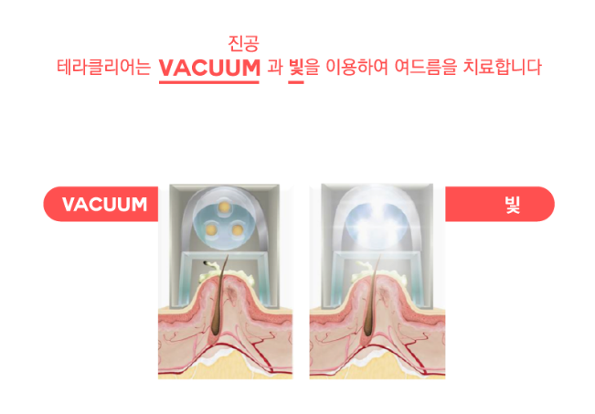 봄꽃축제 시즌, 꽃가루알레르기 피부염 조심하세요! (잠실고운세상피부과) 관련 이미지 9