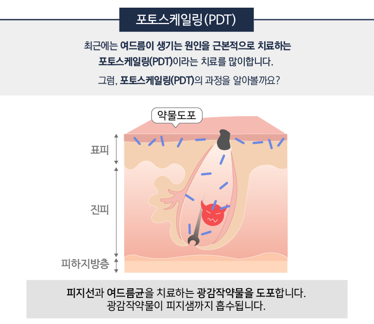 잠실에서만 만나보실 수 있는 특별한 핌클케어 프로그램! (잠실고운세상/여드름치료/핌클케어/잠실여드름피부과) 관련 이미지 4