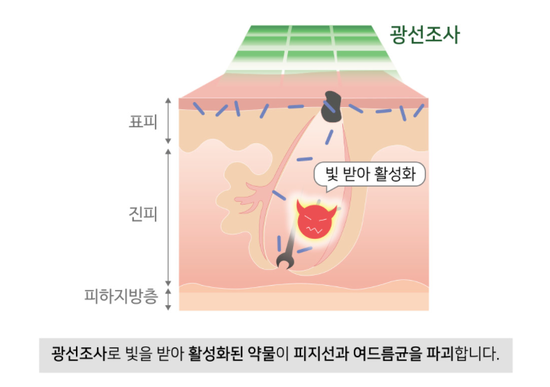 잠실여드름피부과 J핌클케어입니다 (잠실고운세상피부과/잠실역피부과) 관련 이미지 6
