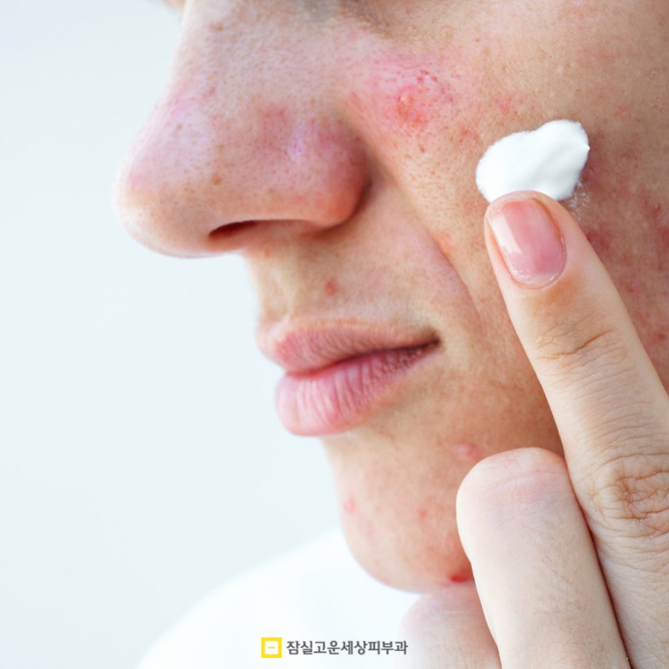 여드름, 반복되는 고민에서 벗어나려면? 관련 이미지 2