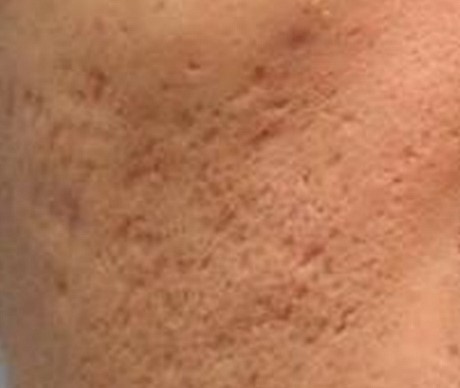 잠실피부관리 메디컬스킨케어로 연휴 후유증 극복! (잠실고운세상피부과/잠실피부과/여드름치료/메디컬스킨케어) 관련 이미지 4