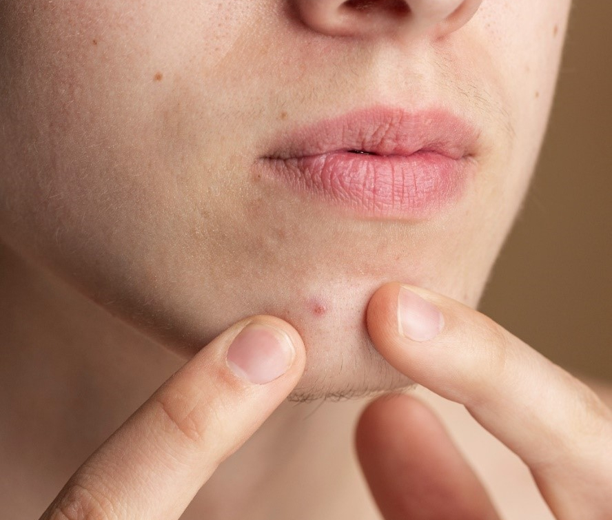 지속되는 여드름, 원인과 치료 방법 관련 이미지 4