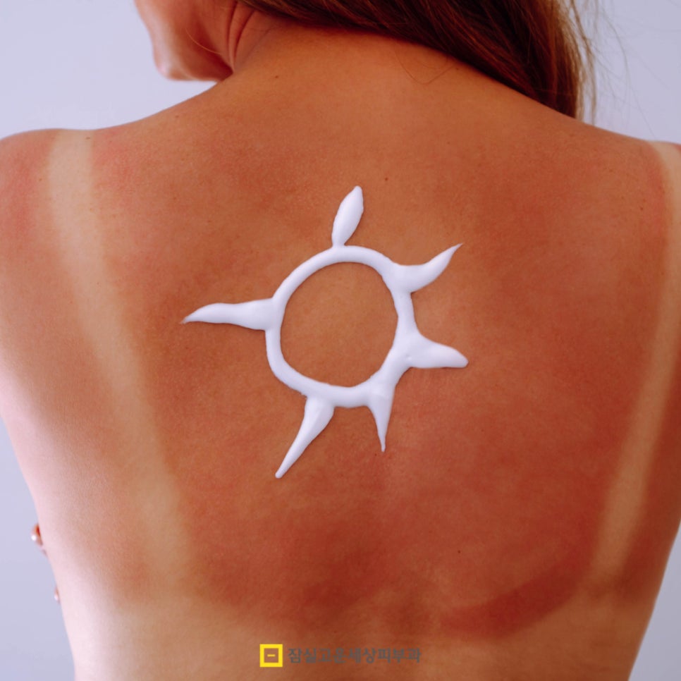 여름철 피부 발진, 제대로 알고 예방하는 방법 관련 이미지 10