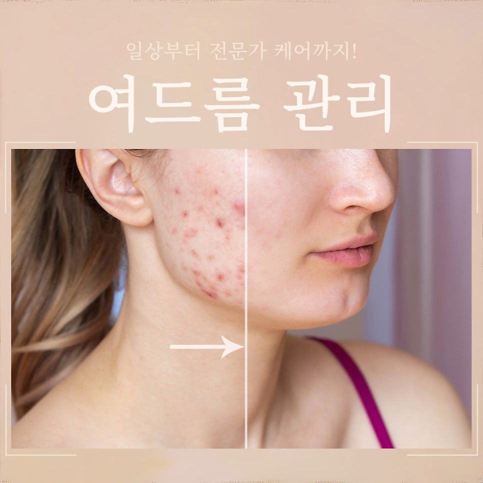 여드름, 일상부터 전문가 케어까지! 관련 이미지 1
