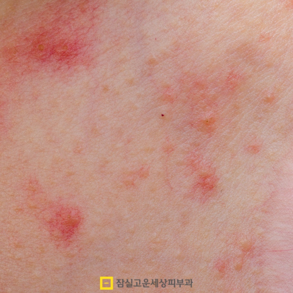 갑자기 트러블이 많아졌다면, 환절기 알러지성 피부일 수도 있어요 관련 이미지 6