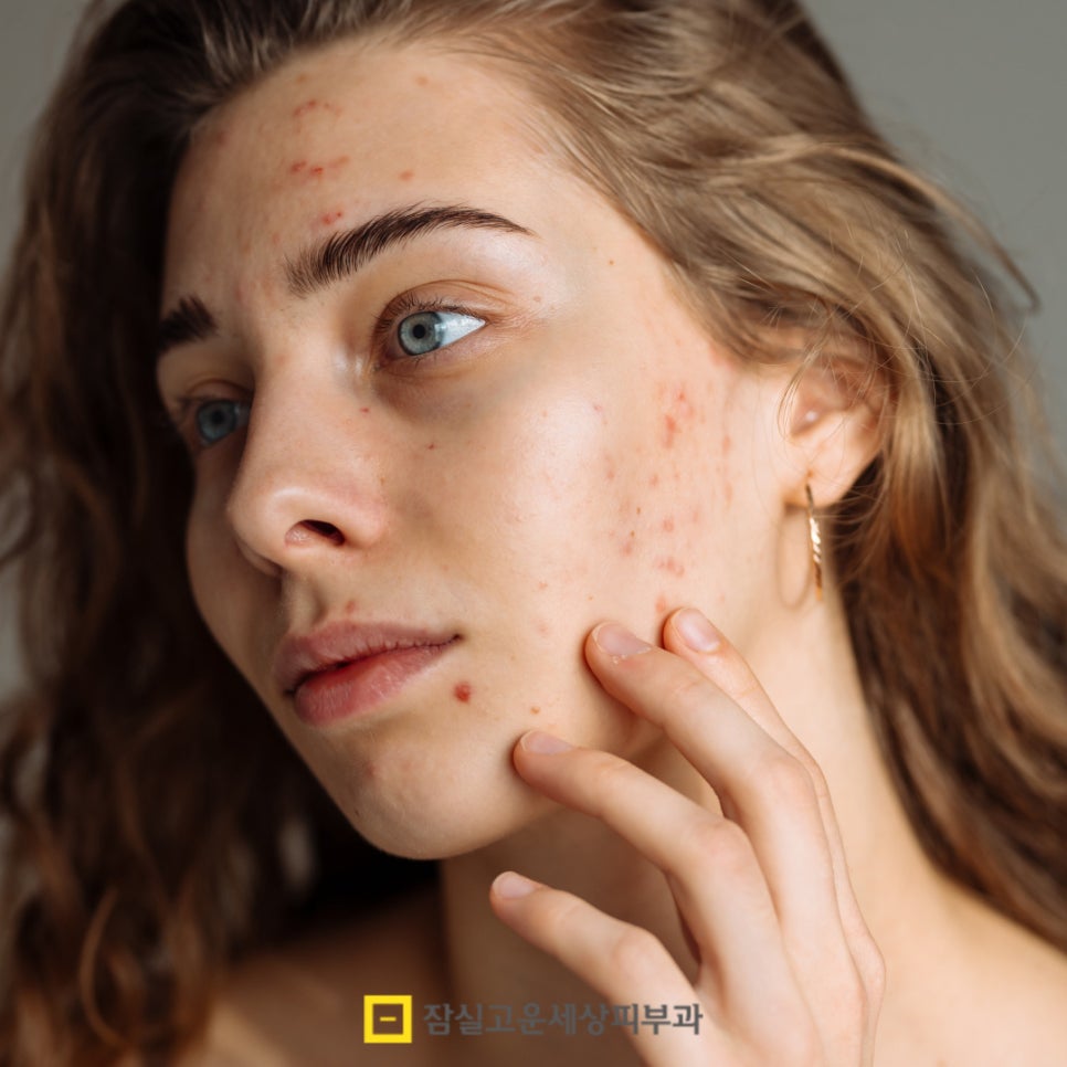 여드름 압출, 왜 해야 하고 어떻게 해야 안전할까? 관련 이미지 2