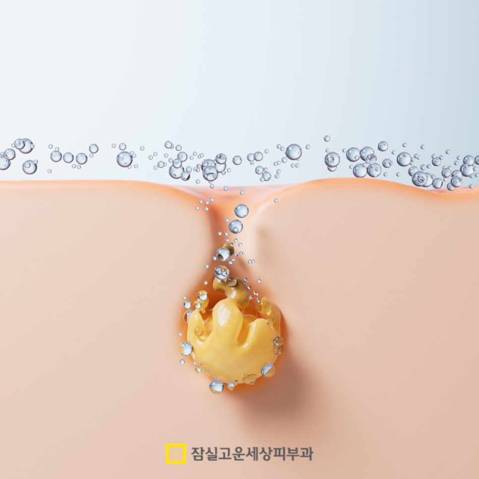 여드름, 왜 흉터로 남을까? 그리고 어떻게 예방할까? 관련 이미지 8