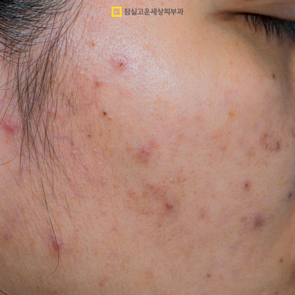 여드름 Q&A, 주요 궁금증들 관련 이미지 11