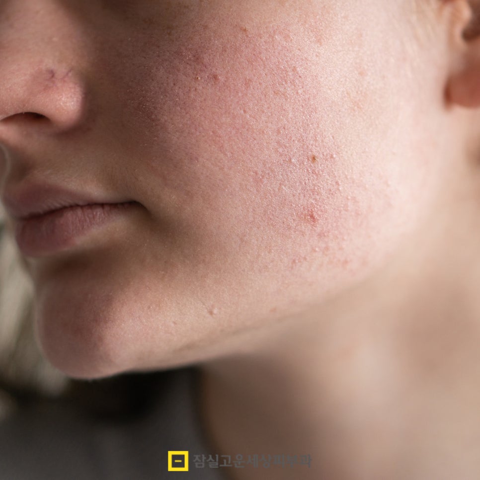 환절기 피부 고민, 딱 1가지 시술만 받는다면? 관련 이미지 3