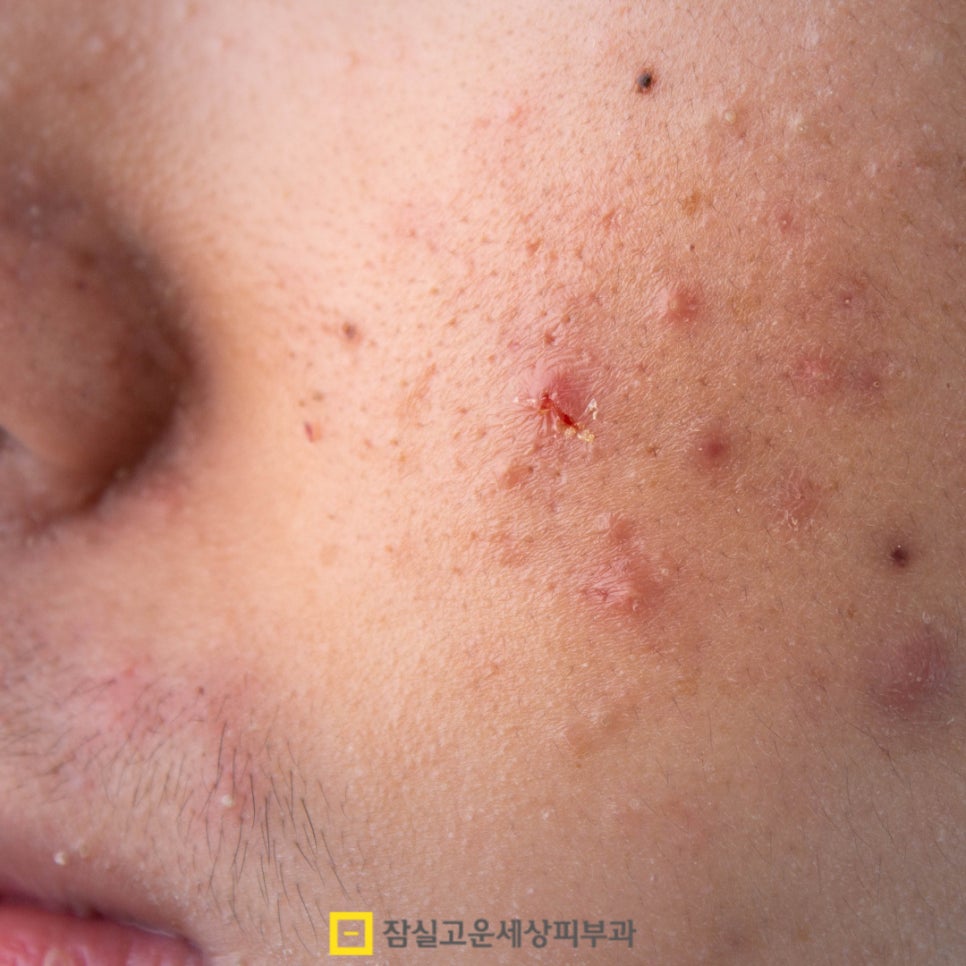 피부과 여드름 치료, 얼마나 오래 다녀야 하나요? 관련 이미지 4