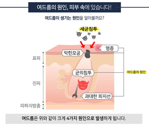 잠실역피부과, 여드름 없는 깨끗한 피부를 위해서! 관련 이미지 3