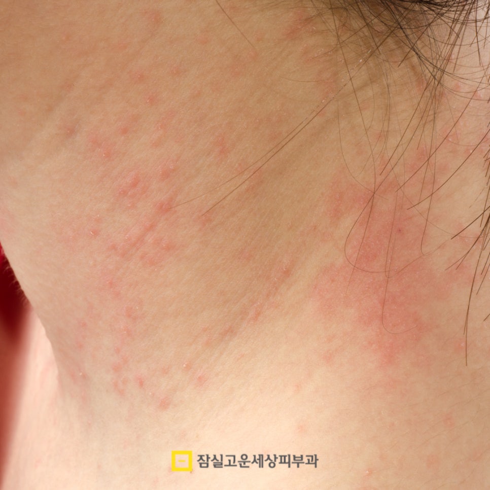 피부질환, 단순 트러블이 아닙니다. 관련 이미지 2
