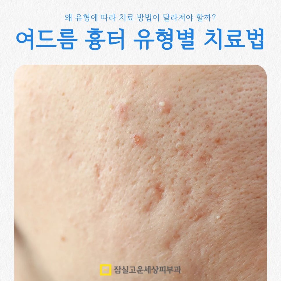 여드름 흉터, 왜 유형에 따라 치료 방법이 달라져야 할까? 관련 이미지 1