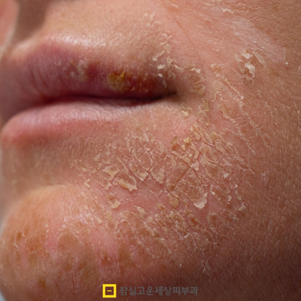 환절기에 더 심해지는 피부 건조, 어떻게 관리해야 할까? 관련 이미지 6