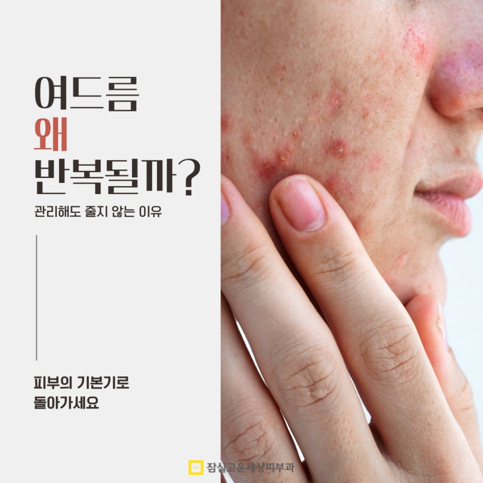 여드름, 반복되는 고민에서 벗어나려면? 관련 이미지 1