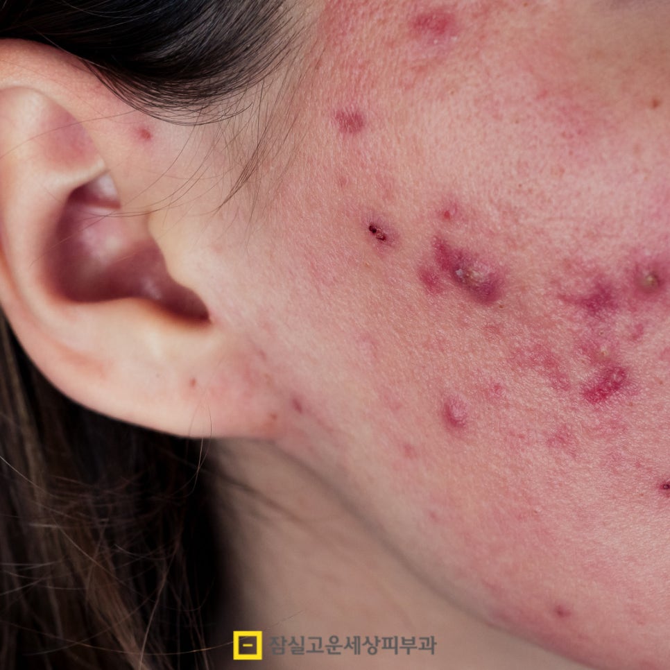 여드름, 단순한 뾰루지가 아닌 피부 질환 관련 이미지 11