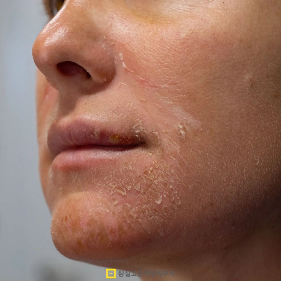 건조한데 기름지는 피부? 손건조부터 장벽까지, 타입별 진단 가이드 관련 이미지 2