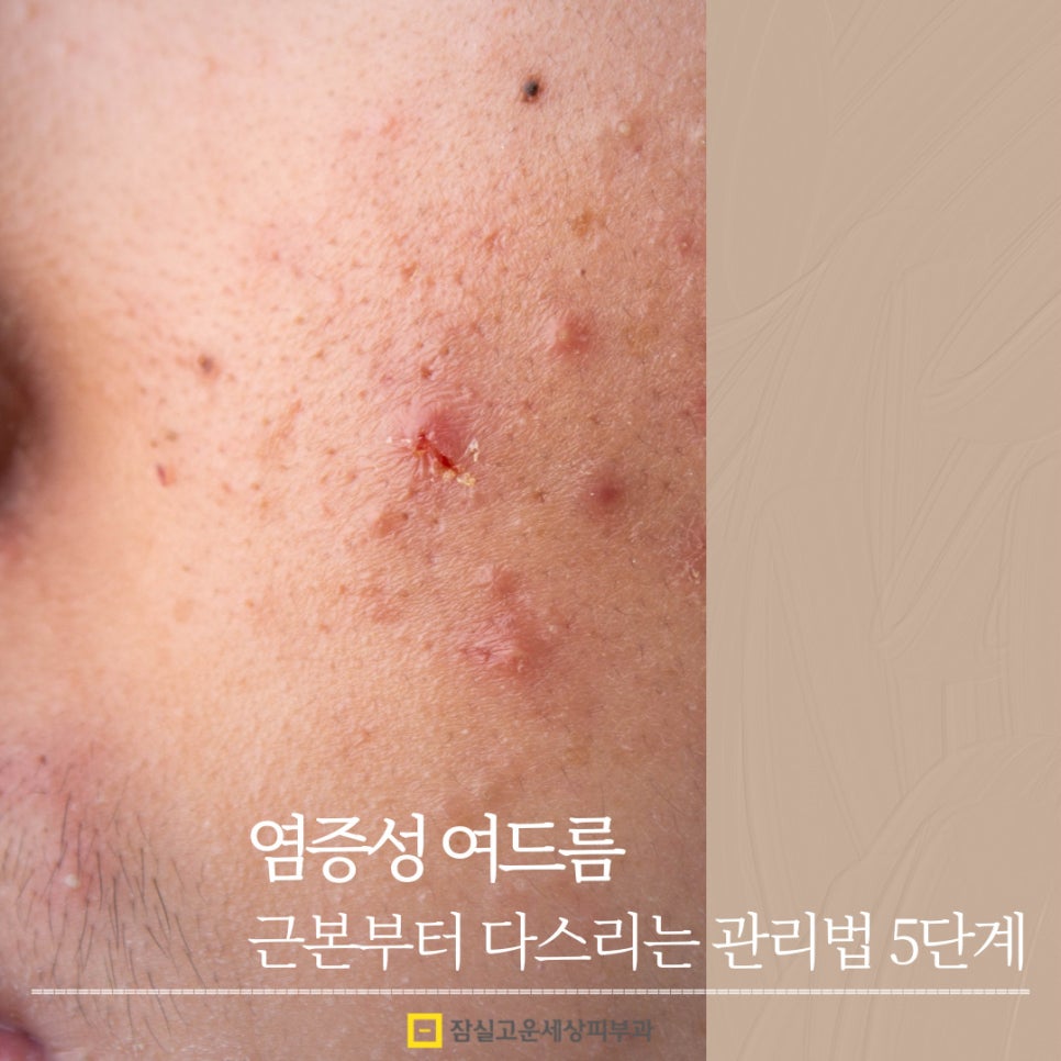 염증성 여드름, 근본부터 다스리는 관리법 5단계 관련 이미지 1