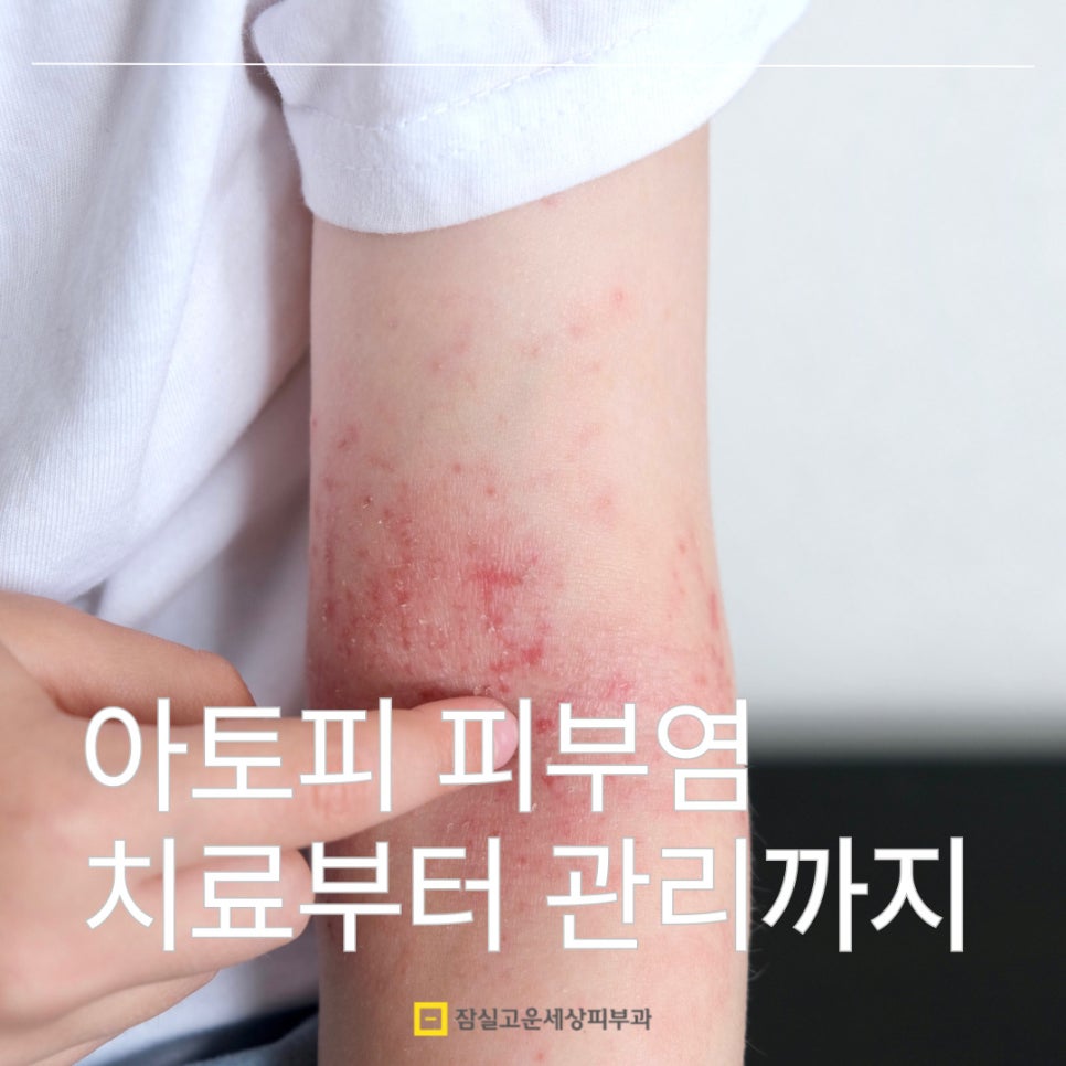 아토피 피부염 완전 가이드 관련 이미지 1