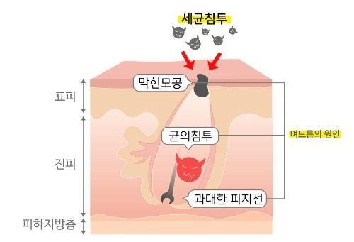 지긋지긋한 여름 여드름, 잠실피부과에서 관리부터 치료법까지 제대로 알아봐요! (잠실고운세상피부과/잠실피부과추천/잠실PDT/잠실여드름/잠실역피부과) 관련 이미지 2