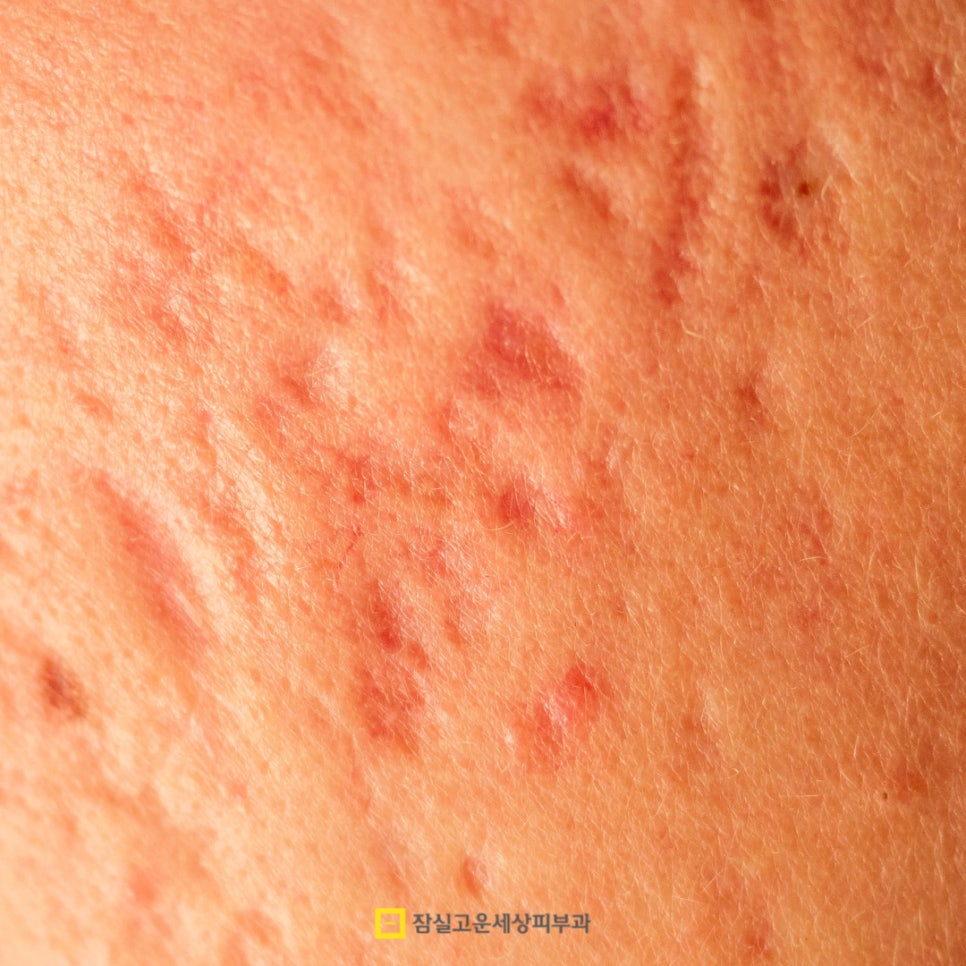 여드름 흉터, 시간이 지나도 사라지지 않는 이유 관련 이미지 2