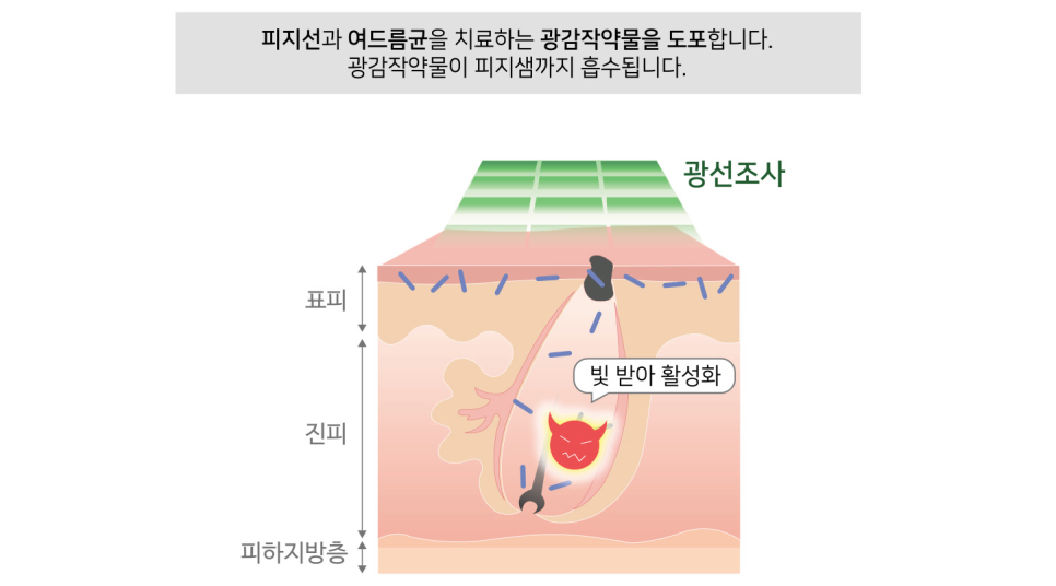 잠실여드름피부과 J핌클케어 여드름치료 관련 이미지 5