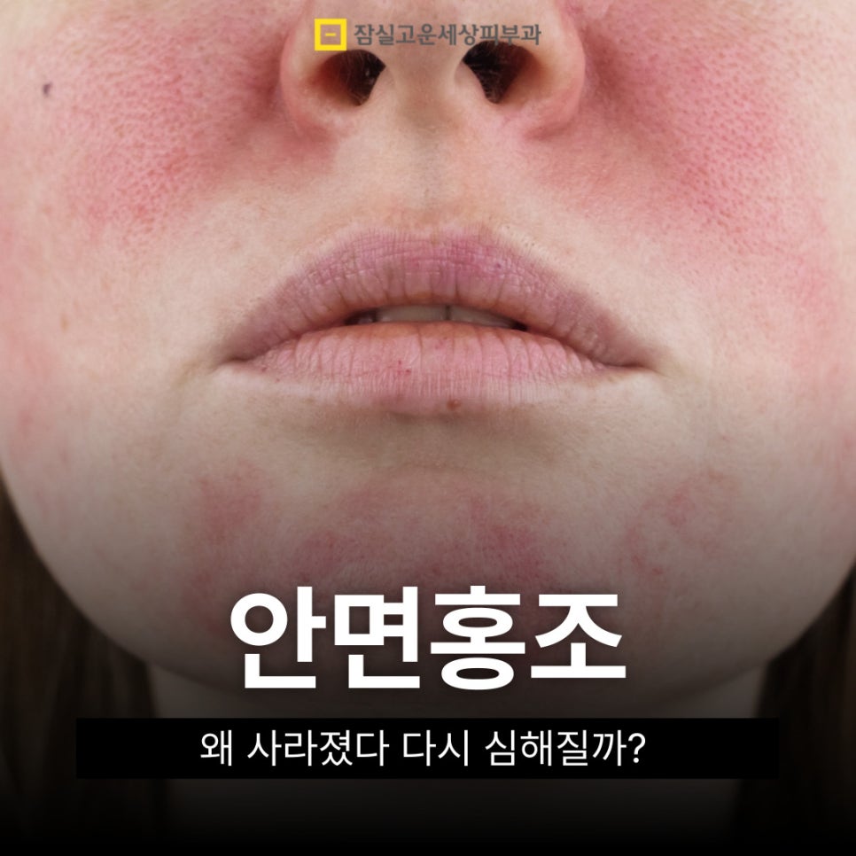 안면홍조, 왜 사라졌다가 다시 심해질까? 관련 이미지 1