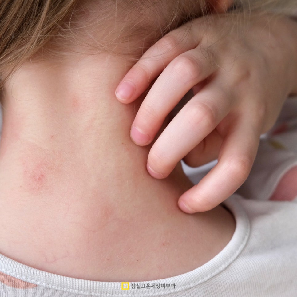 아토피 피부염, 일상에서 지키는 4가지 핵심 관리법 관련 이미지 4