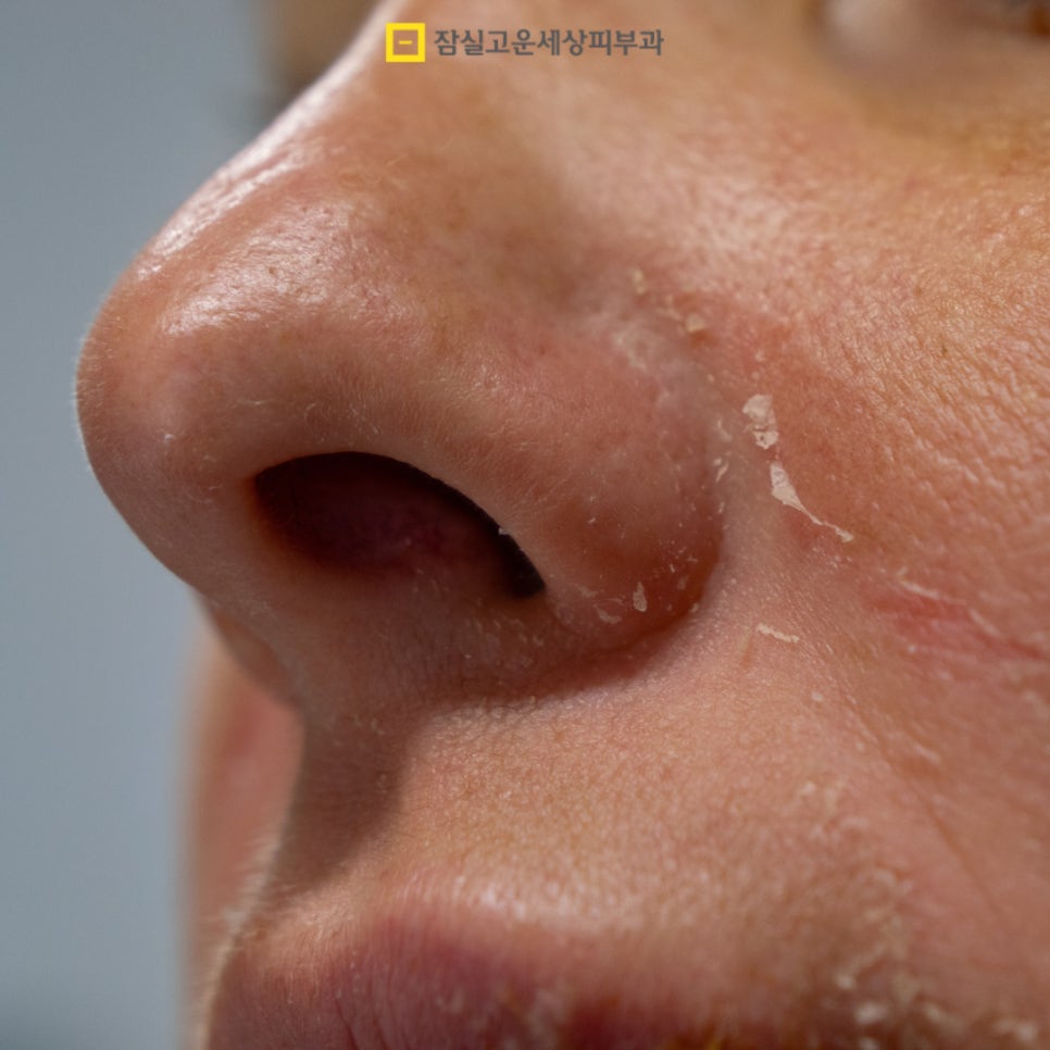 수분부족형 지성, 환절기에 더 건조해지는 이유 관련 이미지 7