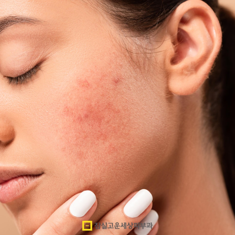 환절기 피부 고민, 딱 1가지 시술만 받는다면? 관련 이미지 7