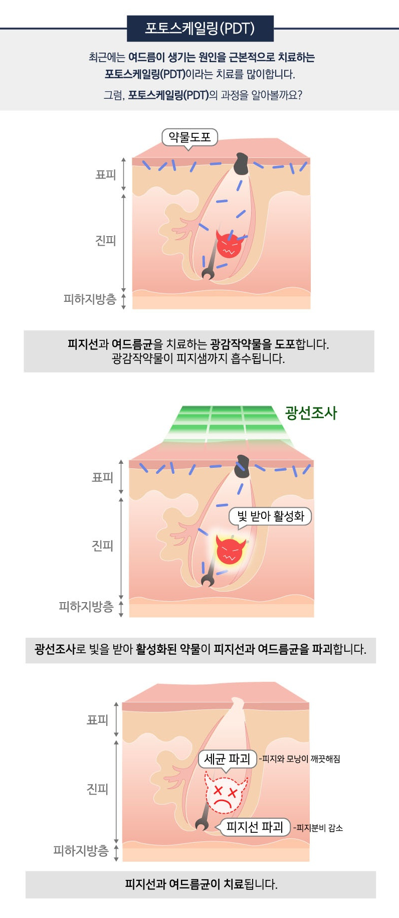잠실역피부과, 여드름 없는 깨끗한 피부를 위해서! 관련 이미지 4