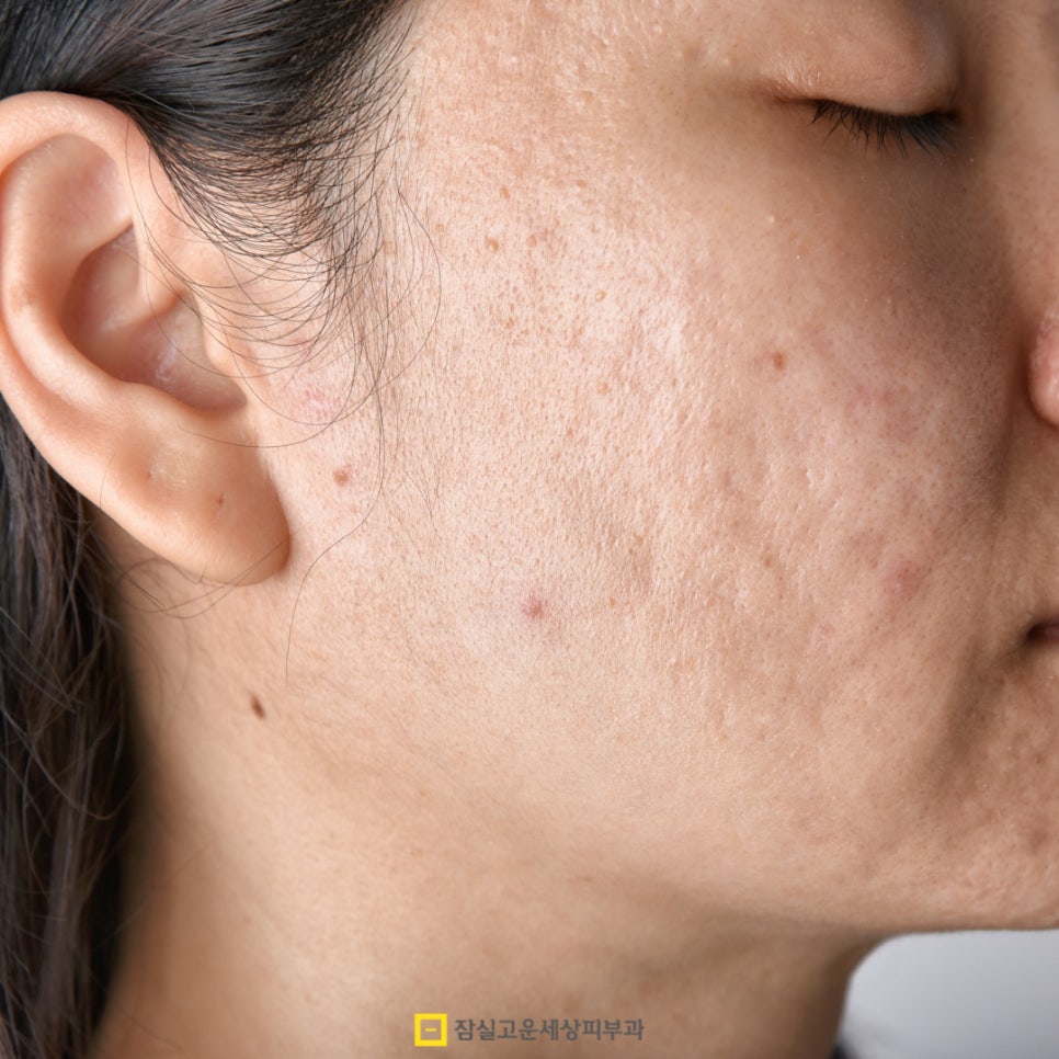 여름철 여드름, 악순환을 끊는 피부 관리법 관련 이미지 8