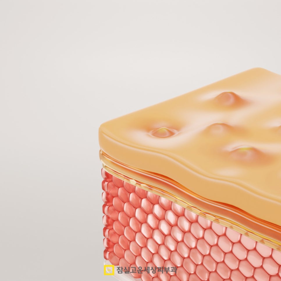 여드름, 왜 치료해도 다시 올라올가? 그리고 재발을 줄이는 방법 관련 이미지 5