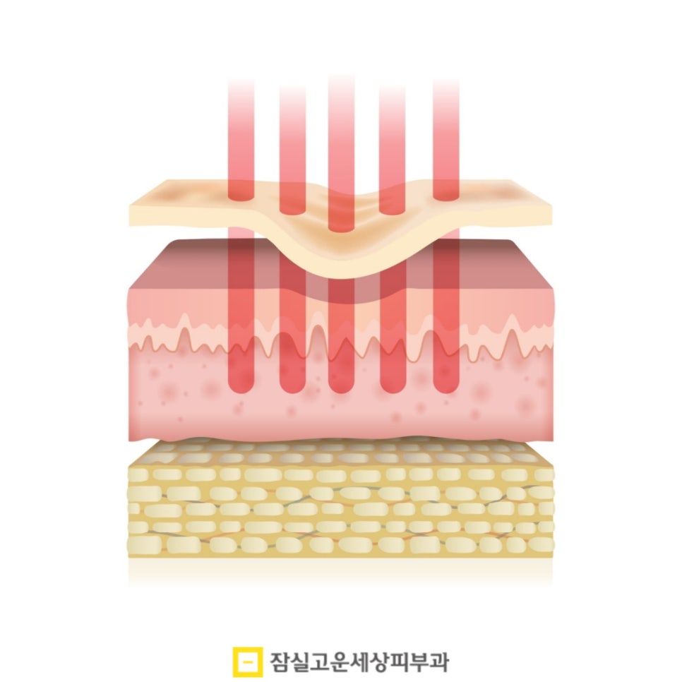 피부과 여드름 치료, 실펌 엑스가 주목받는 이유 관련 이미지 5