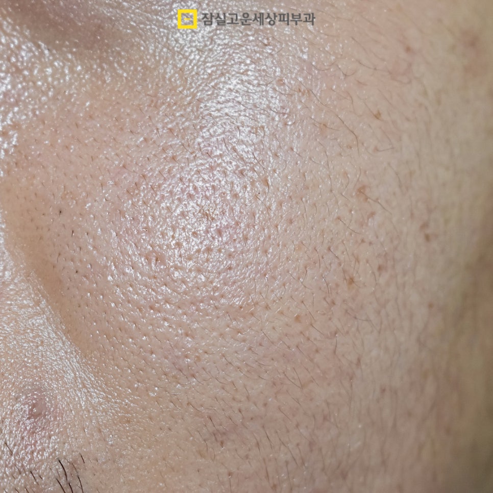 늘어난 모공, 정말 줄일 수 있을까? 관련 이미지 2