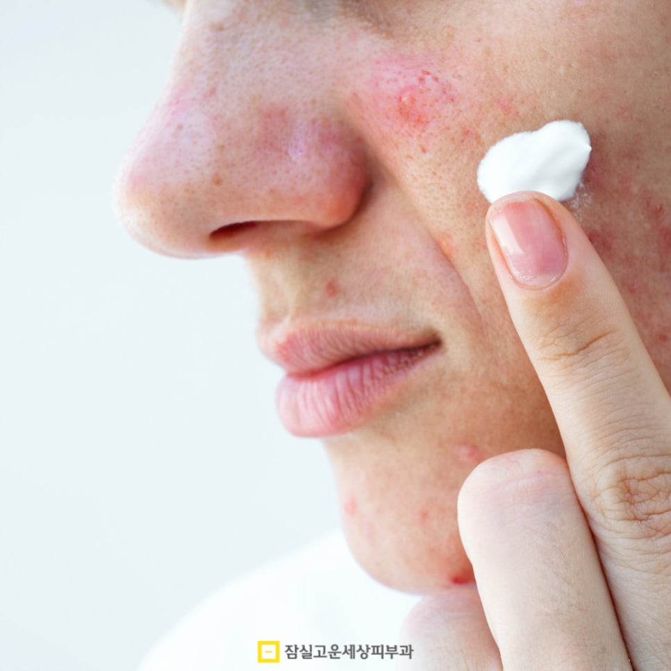 염증성 여드름, 근본부터 다스리는 관리법 5단계 관련 이미지 4