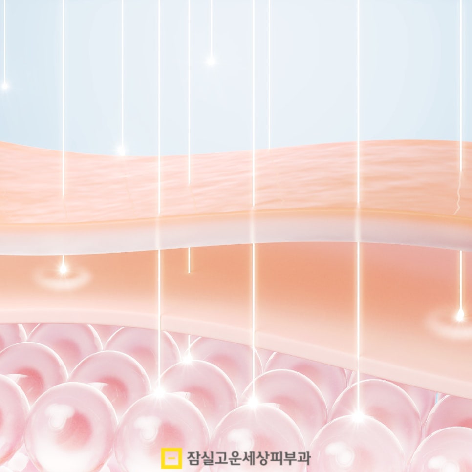 피부과 여드름 치료, 실펌 엑스가 주목받는 이유 관련 이미지 6