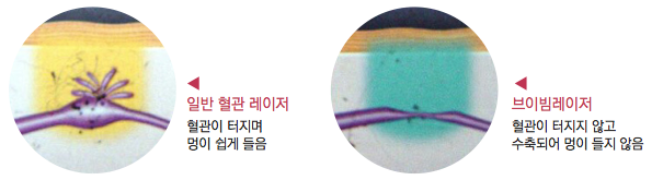 안면홍조 치료방법 어떻게 하나요? (잠실역피부과/여드름자국/흉터치료/튼살) 관련 이미지 7