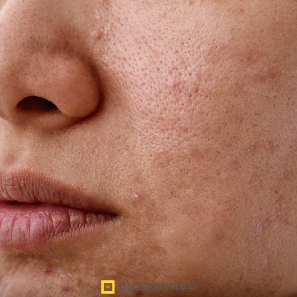 여드름 흉터 치료, 피부 타입별로 접근이 달라야 하는 이유 관련 이미지 3