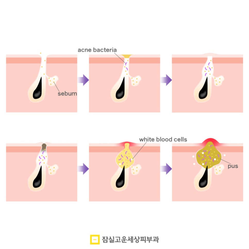 붉고 고름 찬 화농성 여드름의 원인부터 치료까지 관련 이미지 3