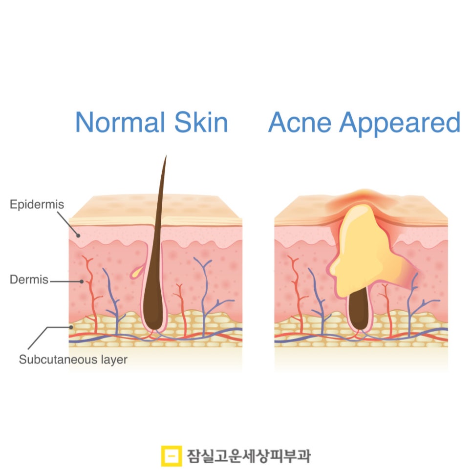 피부과 여드름 치료, 얼마나 오래 다녀야 하나요? 관련 이미지 3
