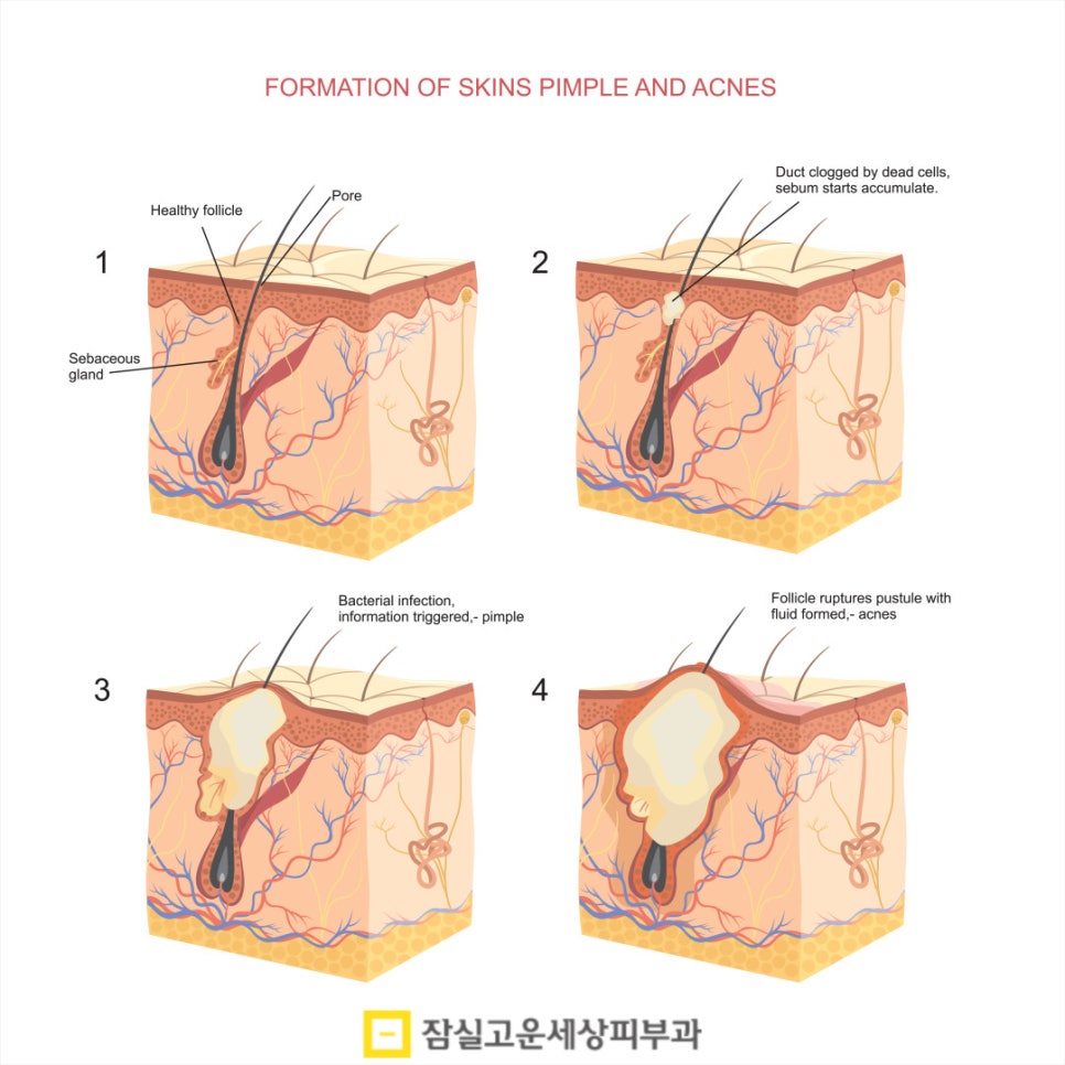 피부과 여드름 치료, 실펌 엑스가 주목받는 이유 관련 이미지 2