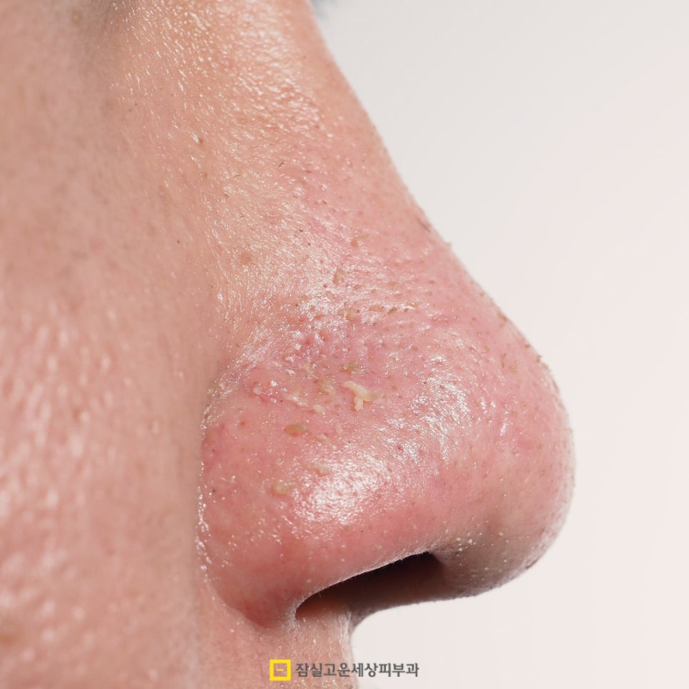 여름철 여드름, 악순환을 끊는 피부 관리법 관련 이미지 2