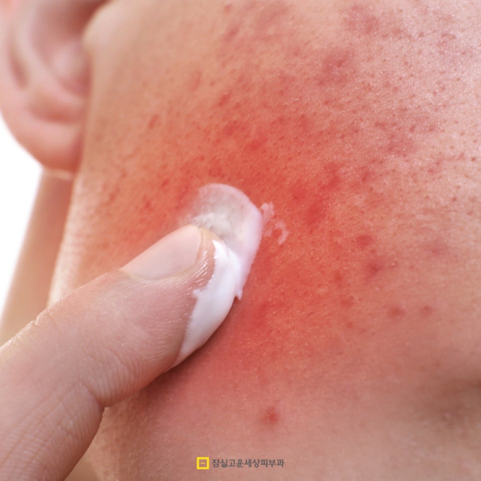 가려움, 홍조까지 부르는 지루피부염, 답은 여기에 있다. 관련 이미지 4