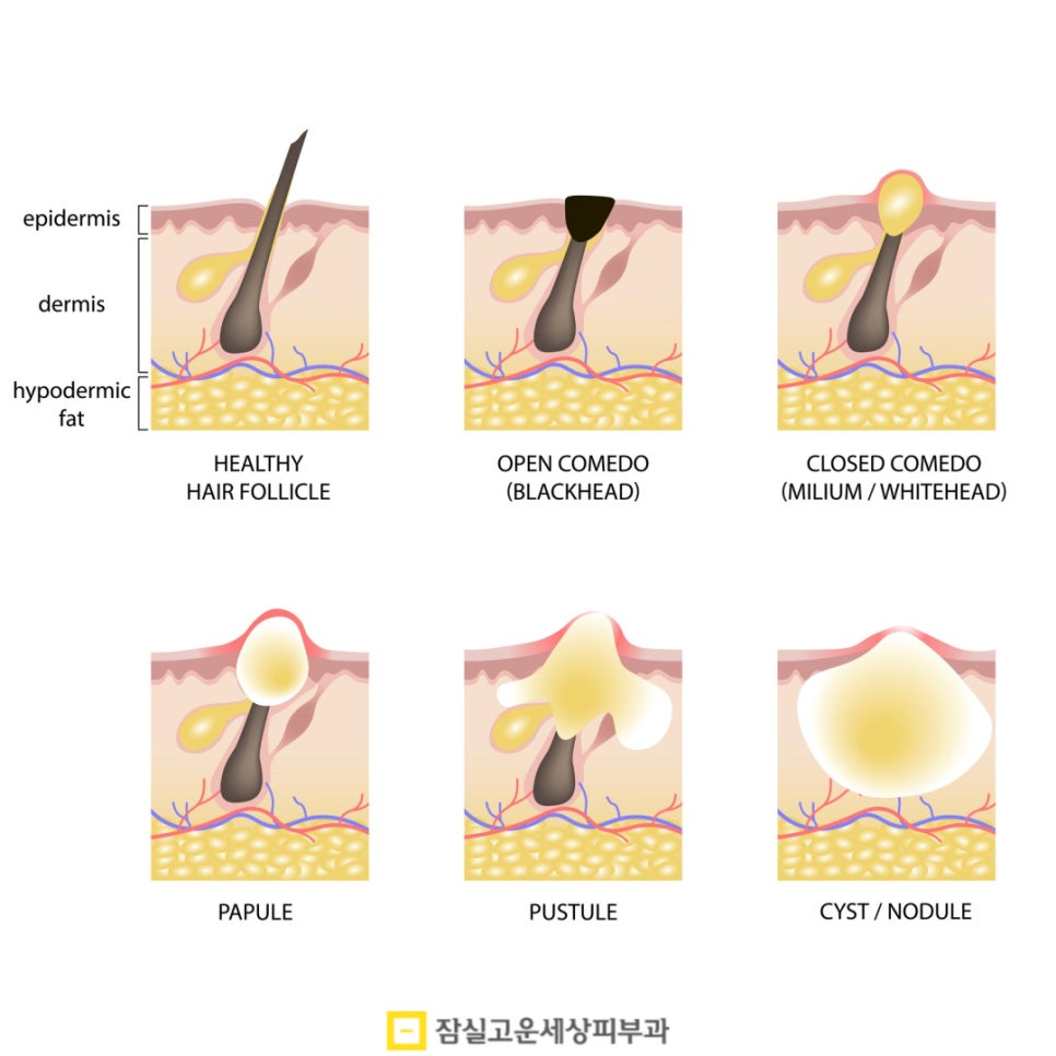 여드름, 흉터까지 번지기 전에 알아야 할 진실 관련 이미지 3