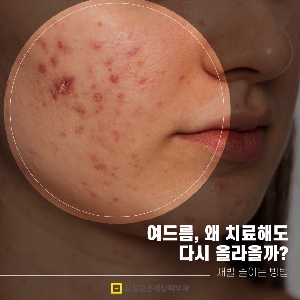 여드름, 왜 치료해도 다시 올라올가? 그리고 재발을 줄이는 방법 관련 이미지 1