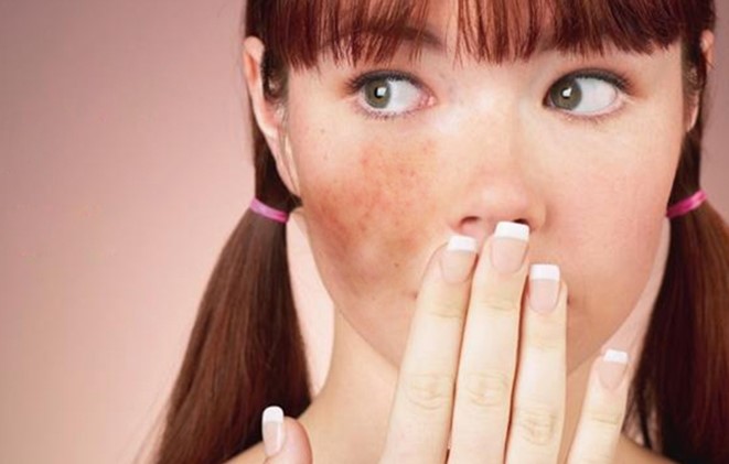 안면홍조 치료방법 어떻게 하나요? (잠실역피부과/여드름자국/흉터치료/튼살) 관련 이미지 2