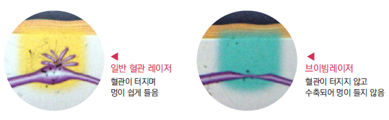 얼룩덜룩한 피부 홍조, 잠실고운세상피부과만의 특별한 관리법! 관련 이미지 4